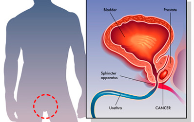 Cáncer de próstata